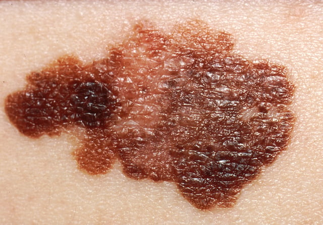A malignant melanoma can often be suspected from sight, but confirmation of the diagnosis or outright removal requires an excisional biopsy.