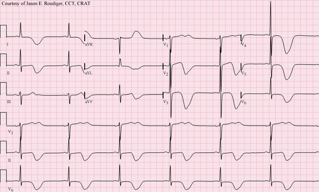 12-lead ECG of a patient with a stroke, showing large deeply inverted T-waves. Various ECG changes may occur in people with strokes and other brain disorders.