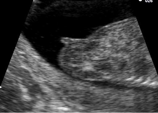 Genital tubercle of female at fourteen weeks