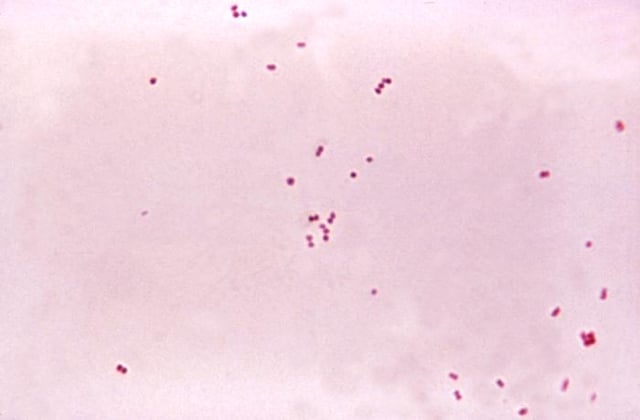 Gram stain of meningococci from a culture showing Gram negative (pink) bacteria, often in pairs