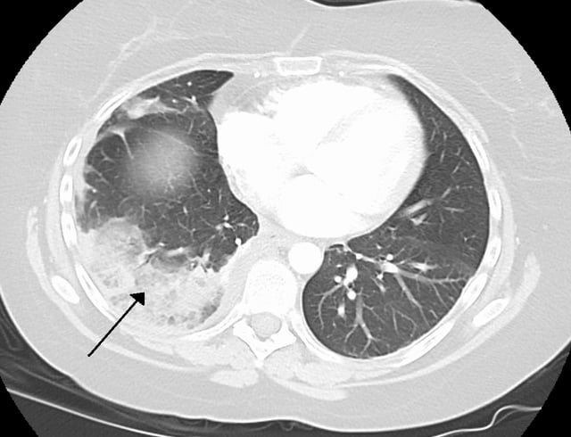 Infarction of the lung due to a pulmonary embolism