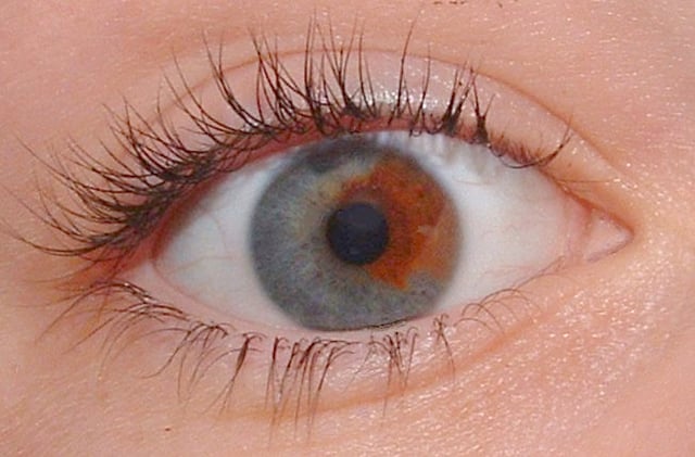 An example of sectoral heterochromia. The subject has a blue iris with a brown section.