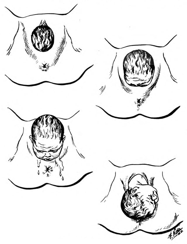 Stages in the birth of the baby's head.