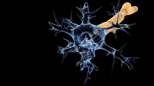 Guillain–Barré syndrome – demyelination