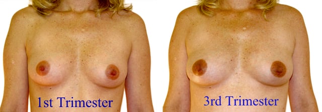 Breast changes as seen during pregnancy. The areolae are larger and darker.