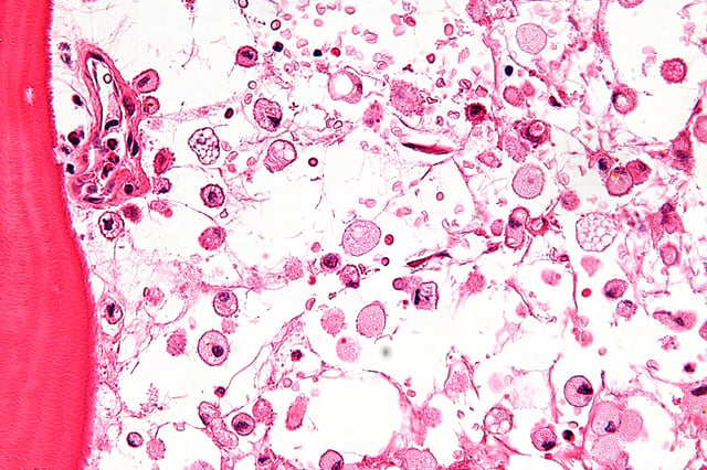 Micrograph showing crinkled paper macrophages in the marrow space in a case of Gaucher disease, H&E stain.