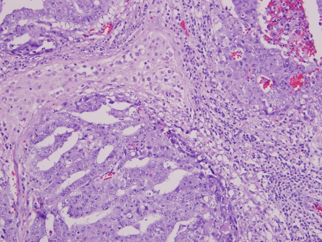 Mixed germ cell tumor containing embryonal carcinoma, seminoma, and yolk sac tumor.