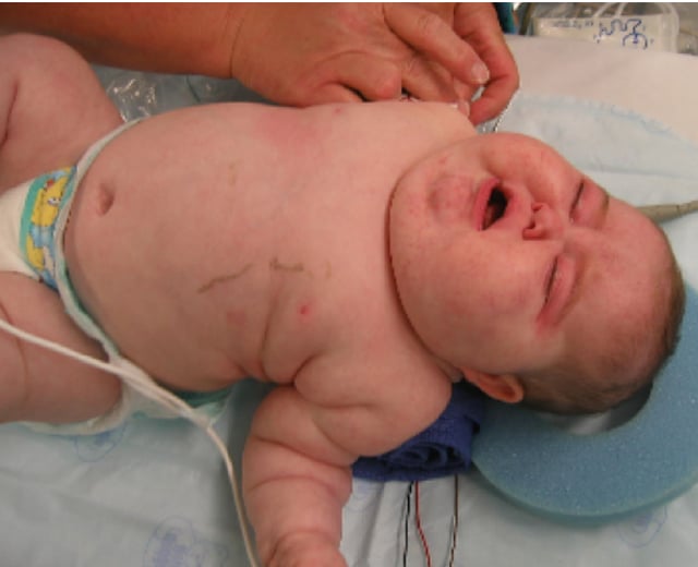 Features of Cushing syndrome including a round face, acne, reddish skin, central obesity, and poor muscle tone