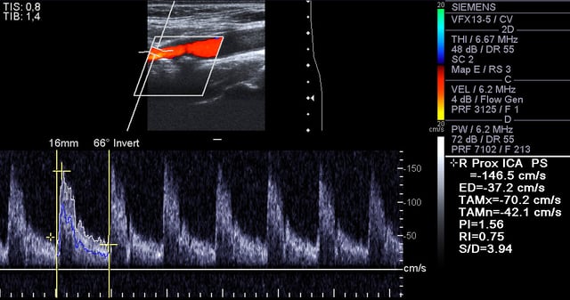 Doppler ultrasound of right internal Carotid artery with calcified and non-calcified plaques showing less than 70% stenosis