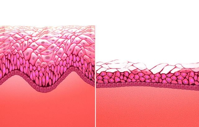 Pre-menopausal vaginal mucosa (left) versus menopausal vaginal mucosa (right)
