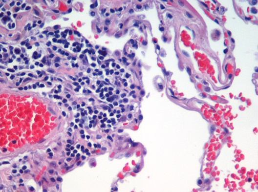 Lung tissue affected by emphysema using H&E stain