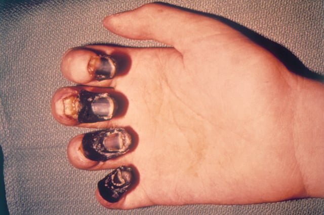 A hand showing how acral gangrene of the fingers due to bubonic plague causes the skin and flesh to die and turn black