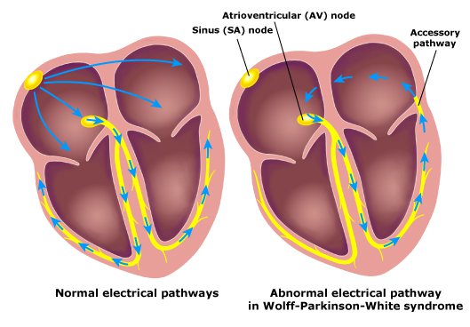 Graphic representation of the bundle of Kent in Wolff–Parkinson–White syndrome