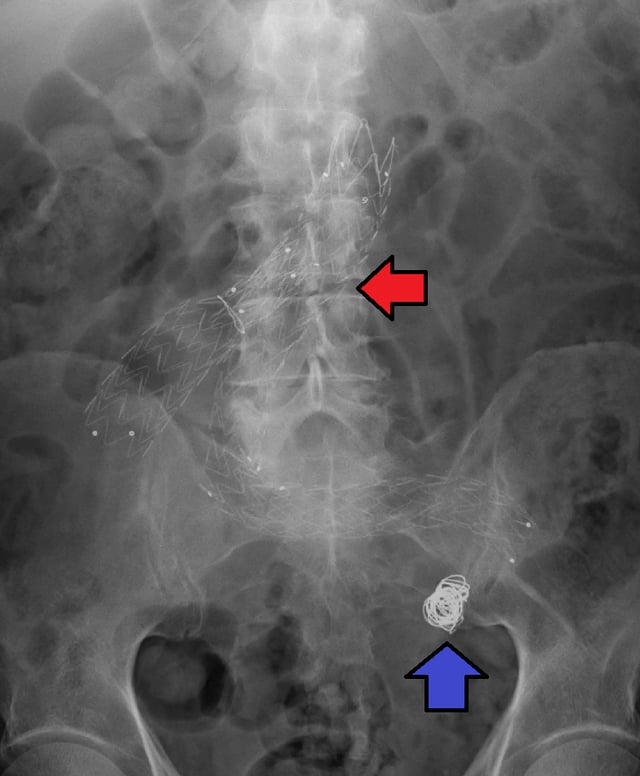 Endovascular stent and endovascular coil