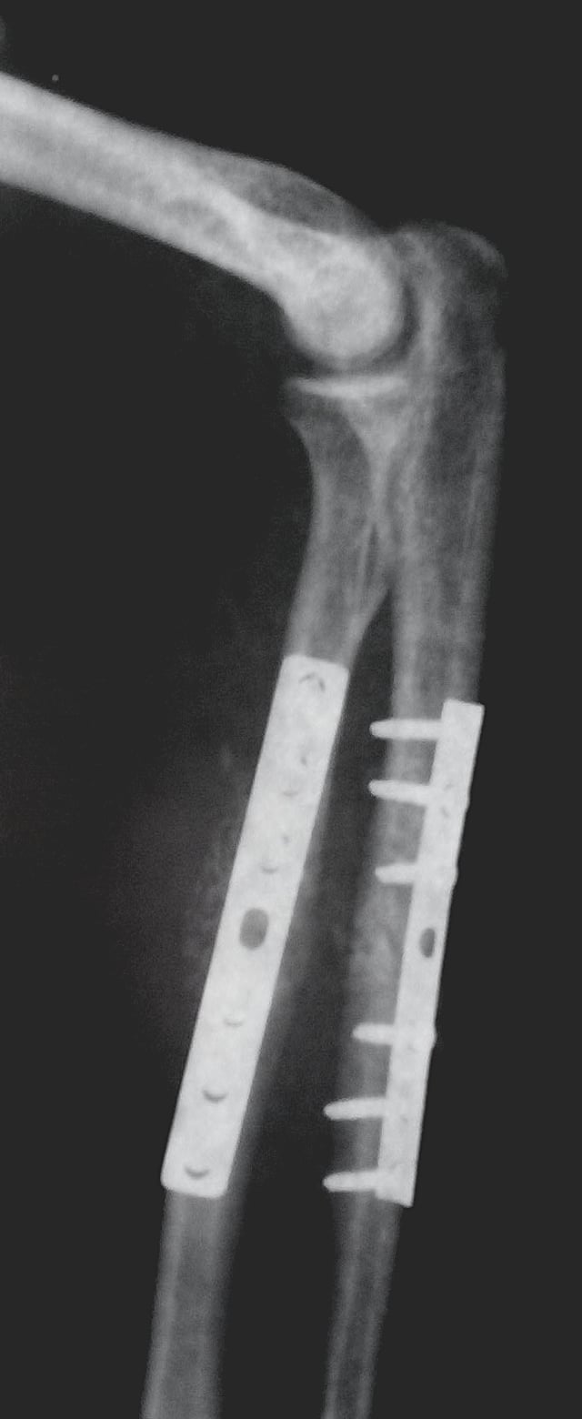 Orthopedic implants to repair fractures to the radius and ulna. Note the visible break in the ulna. (right forearm)