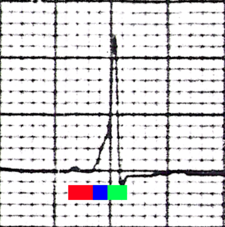 One beat from a rhythm strip in V2 demonstrating characteristic findings in Wolff–Parkinson–White syndrome: Note the characteristic delta wave (above the blue bar), the short PR interval (red bar) of 80 ms, and the long QRS complex (blue bar plus green bar) at 120 ms.