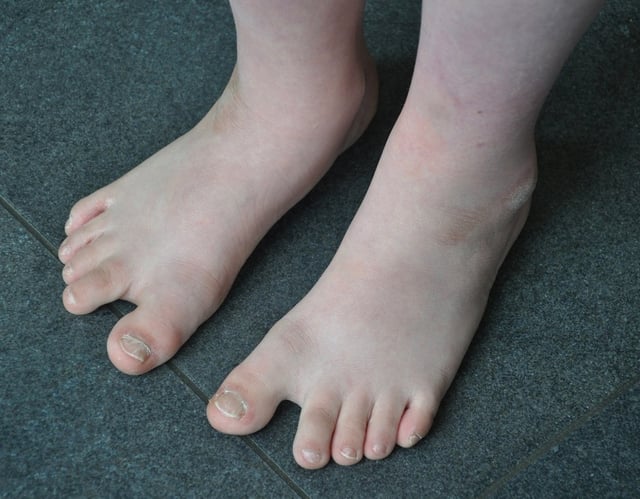 Feet of a boy with Down syndrome
