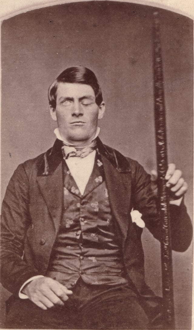 Phineas Gage displayed ptosis after a large iron rod entered his left cheek, passed behind his left eye, and exited at the top of his head