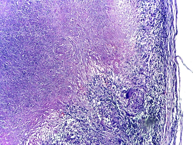 Microscopy of tuberculous epididymitis.
