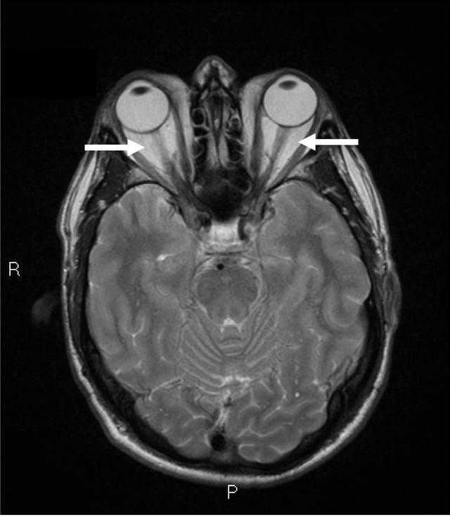 Magnetic resonance imaging of the orbits, showing congestion of the retro-orbital space and enlargement of the extraocular muscles (arrows), consistent with the diagnosis of Graves' ophthalmopathy.