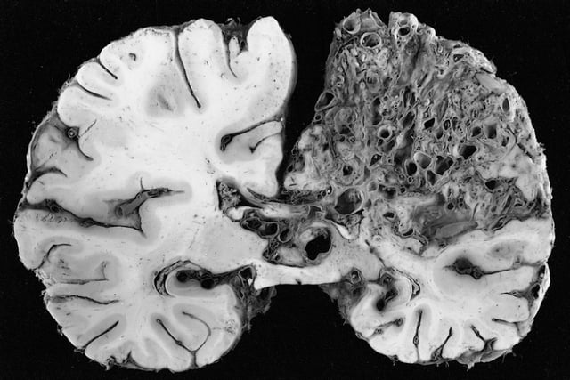 This coronal cross-section of a brain reveals a significant arteriovenous malformation that occupies much of the parietal lobe.