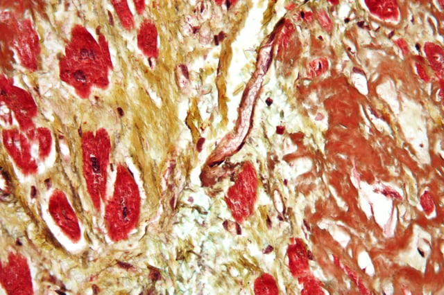 An instance of diagnosis via histopathology, this high-magnification micrograph of a section of cardiac tissue reveals advanced cardiac amyloidosis.  This sample was attained through an autopsy.