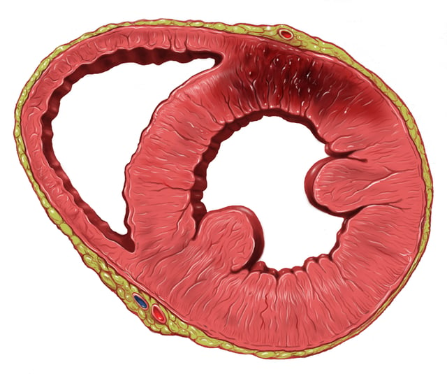 Drawing of the heart showing anterior left ventricle wall infarction
