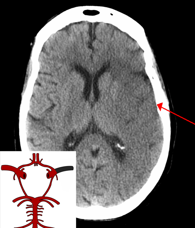 A CT showing early signs of a middle cerebral artery stroke with loss of definition of the gyri and grey white boundary