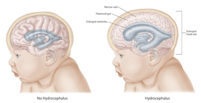 Illustration showing different effects of hydrocephalus on the brain and cranium