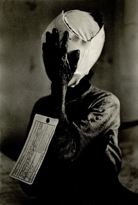 Heavily bandaged woman burned by napalm, with a tag attached to her arm which reads "VNC Female" meaning Vietnamese civilian