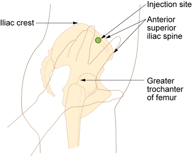 Ventrogluteal site and rectus femoris sites for intramuscular injection