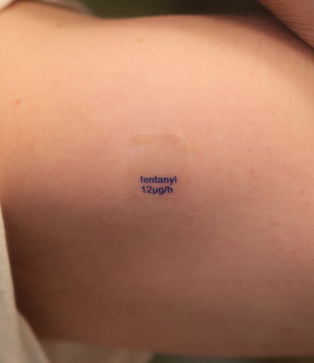 A fentanyl transdermal patch with a release rate of 12 micrograms per hour, on a person's arm