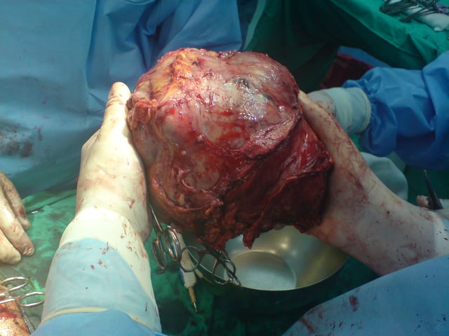 Left lobe liver tumor
