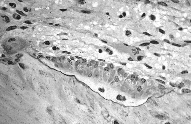 Light micrograph of decalcified cancellous bone displaying osteoblasts actively synthesizing osteoid, containing two osteocytes.