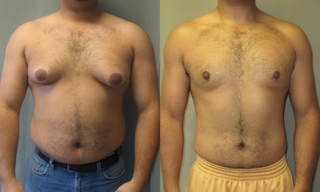 22-year-old man with gynecomastia not due to AAS use.