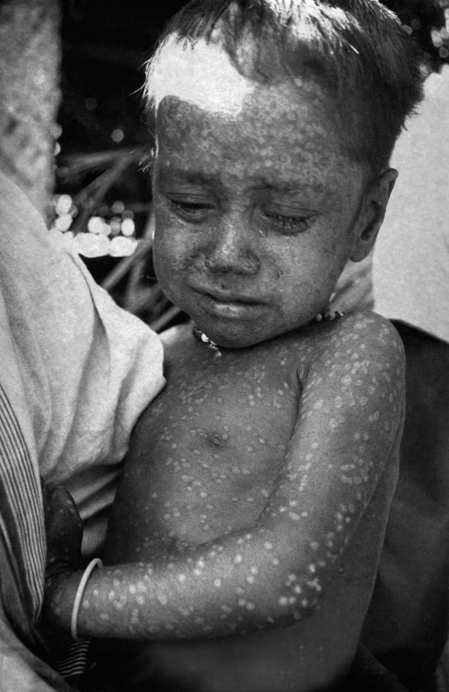 Two-year-old Rahima Banu of Bangladesh (pictured) was the last person infected with naturally occurring Variola major, in 1975.