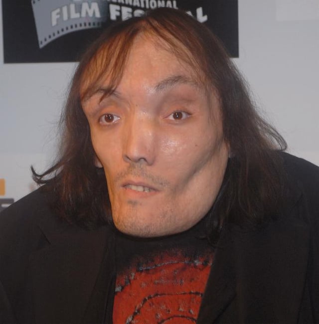 Mauricio Saravia (1970–2008) was an Uruguayan artist with the disease.