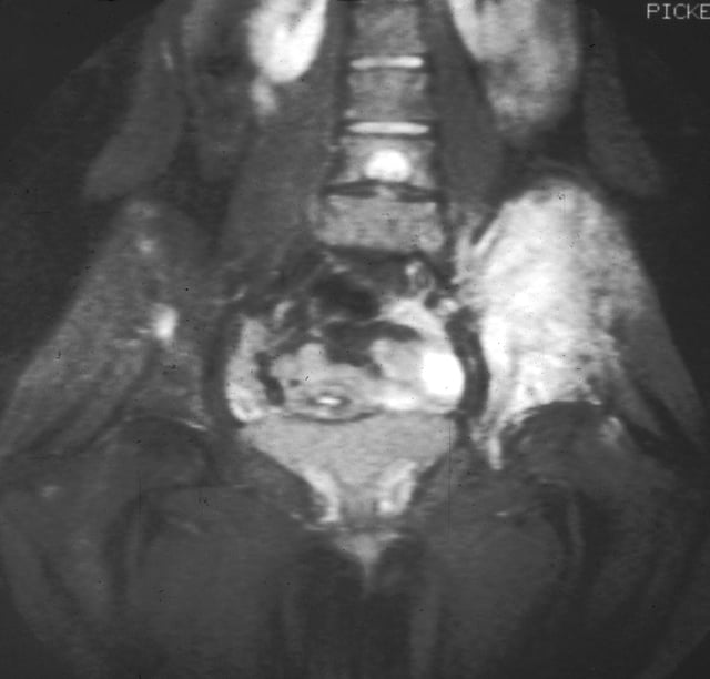 Magnetic resonance imaging slice showing Ewing's sarcoma of the left hip (white area shown right)