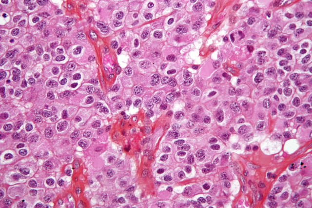 Micrograph of an oligodendroglioma, a type of brain cancer. Brain biopsy. H&E stain