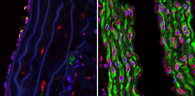Confocal microscopy photographs of the descending aortas of two 15-month-old progeria mice, one untreated (left) and the other treated with the FTI drug tipifarnib (right)
