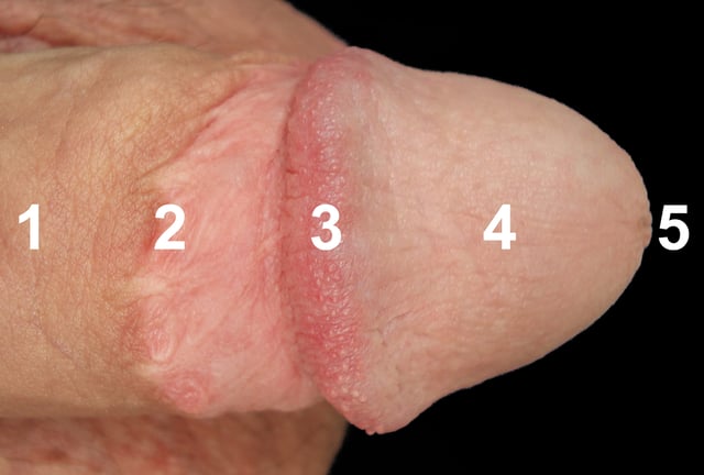 A labelled dorsal view of a circumcised penis: (1) Shaft, (2) Circumcision scar, (3) Corona, (4) Glans, (5) Meatus.