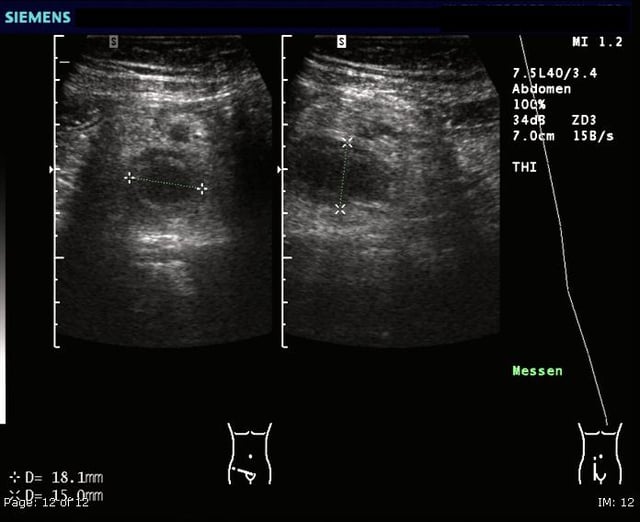 Ultrasound image of acute appendicitis