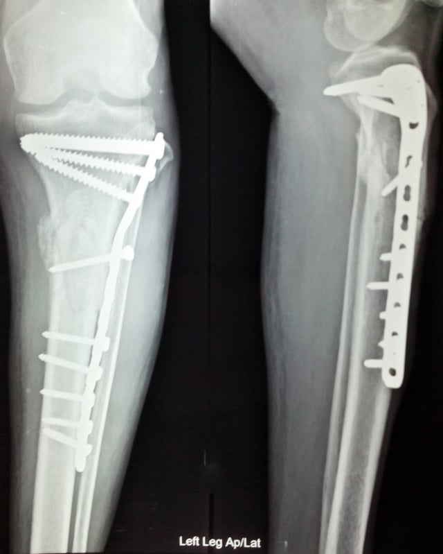 Anterior and lateral view x-rays of fractured left leg with internal fixation after surgery