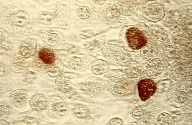 Chlamydia trachomatis inclusion bodies (brown) in a McCoy cell culture.
