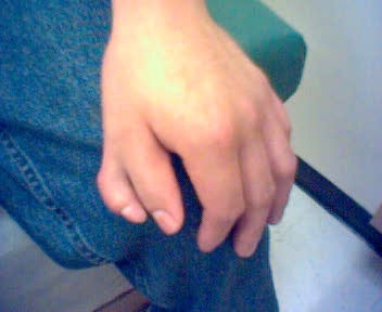 Male with unilateral preaxial polydactyly affecting the left thumb. The supernumerary digit had normal sensation but no joint and hence could not move independently.