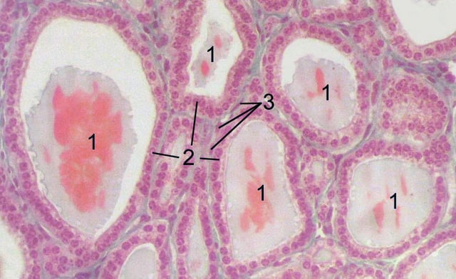 Section of a thyroid gland under the microscope. 1 follicles, 2 follicular cells, 3 endothelial cells