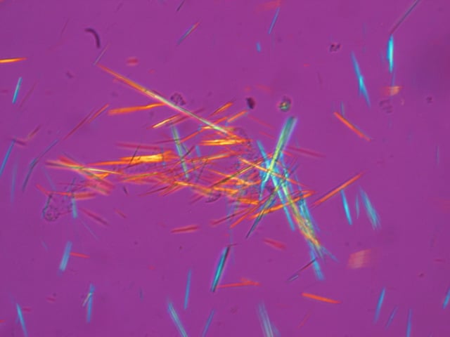 Urate crystals, with the crystals' long axis seen as horizontal in this view being parallel to that of a red compensator filter. These appear as yellow, and are thereby of negative birefringence.