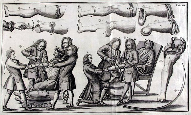The 18th century guide to amputations