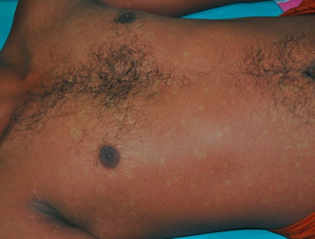 The rash that commonly forms during the recovery from dengue fever with its classic islands of white in a sea of red.