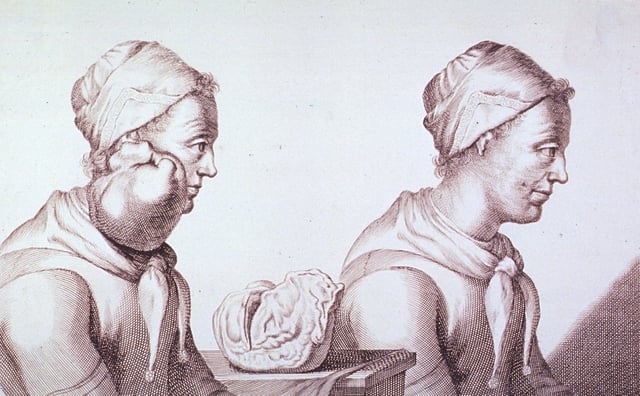 Engraving with two views of a Dutch woman who had a tumor removed from her neck in 1689